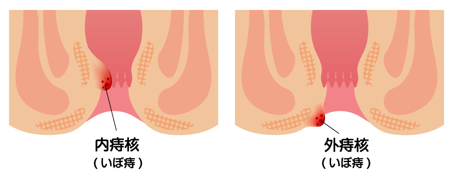 いぼ痔